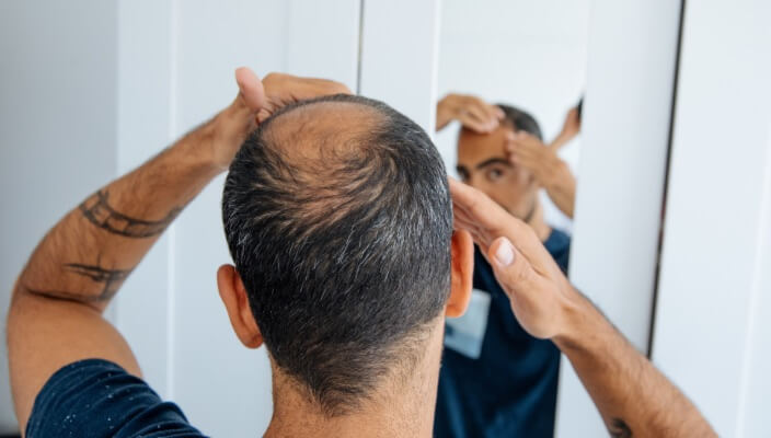 man inspecting hair loss in mirror