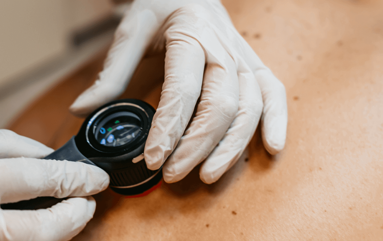 skin cancer screening