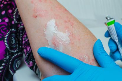 Psoriasis3