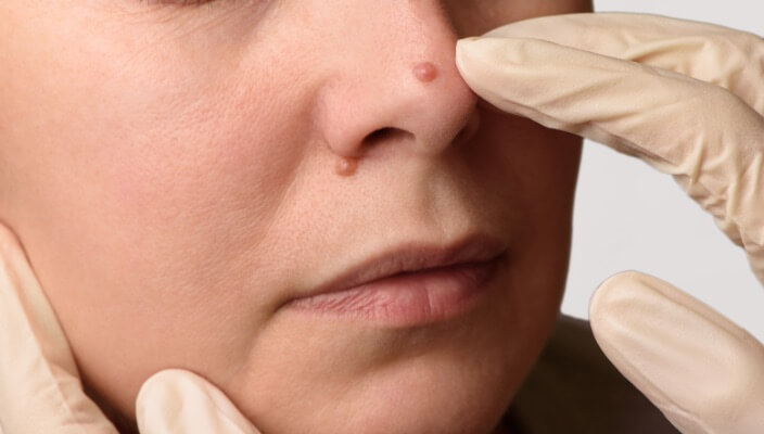up close of skin growth on nose